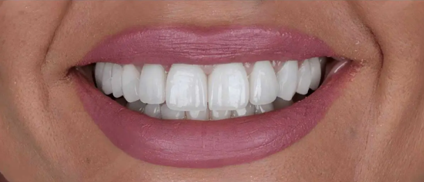 After dental implants treatment