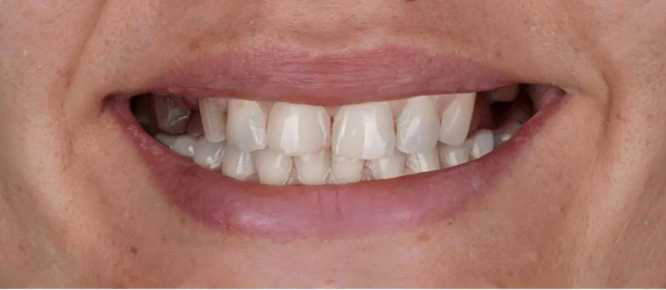 Before dental implants treatment
