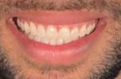 After Invisalign treatment
