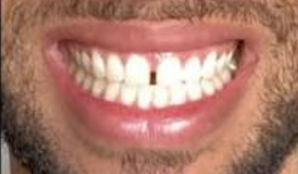 Before Invisalign treatment