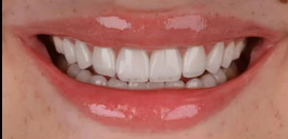 After veneers treatment