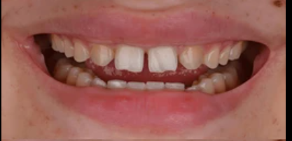 Before veneers treatment